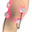 LaserPatch 650: sistema modular de laserterapia y laserpuntura LaserPatch 650: sistema modular de laserterapia y laserpuntura
